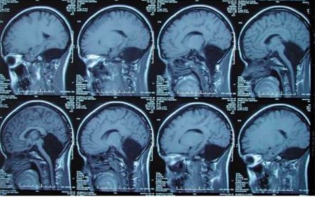 SABCRCanada's tweet photo. ⚠️ Extremely rare case of a living patient without a cerebellum: https://t.co/o2LbnFefMn

#Neuroscience #BrainCancerResearch #BTNews #SABCR https://t.co/yKUwSNE8fk