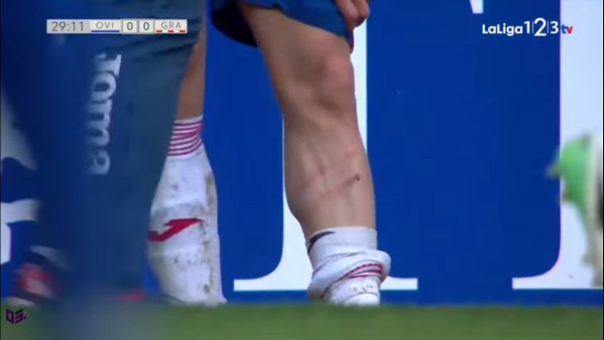 samugarciaj's tweet photo. Las idas de olla de este "jugador"son un peligro para compañeros y rivales y no deben quedar impunes. Agra se llevó un recuerdo a casa y Joselu tuvo que pasar la noche en el hospital. @GranadaCdeF , denunciar es proteger a tus jugadores. #OviedoGranada @LaLiga (2/2) https://t.co/wdQ0xoGn7w