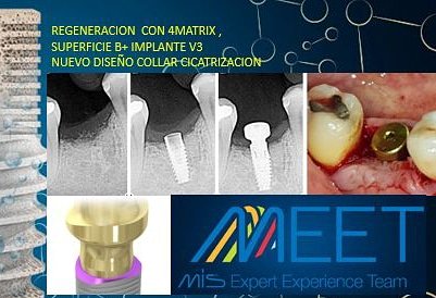 avendanodr's tweet photo. Daily floss news 242. Regeneración osea con 4 matrix y colocación de implante V3 con superficie B+ y collar de cicatrización, para preservar hueso y conectivo en cervical. por Dr. ADRIAN AVENDAÑO. #miselsalvador, #misimplants, #perioimplant, #avendanodr, #v3mis, #4matrix, #meet https://t.co/kPFNQICyxI