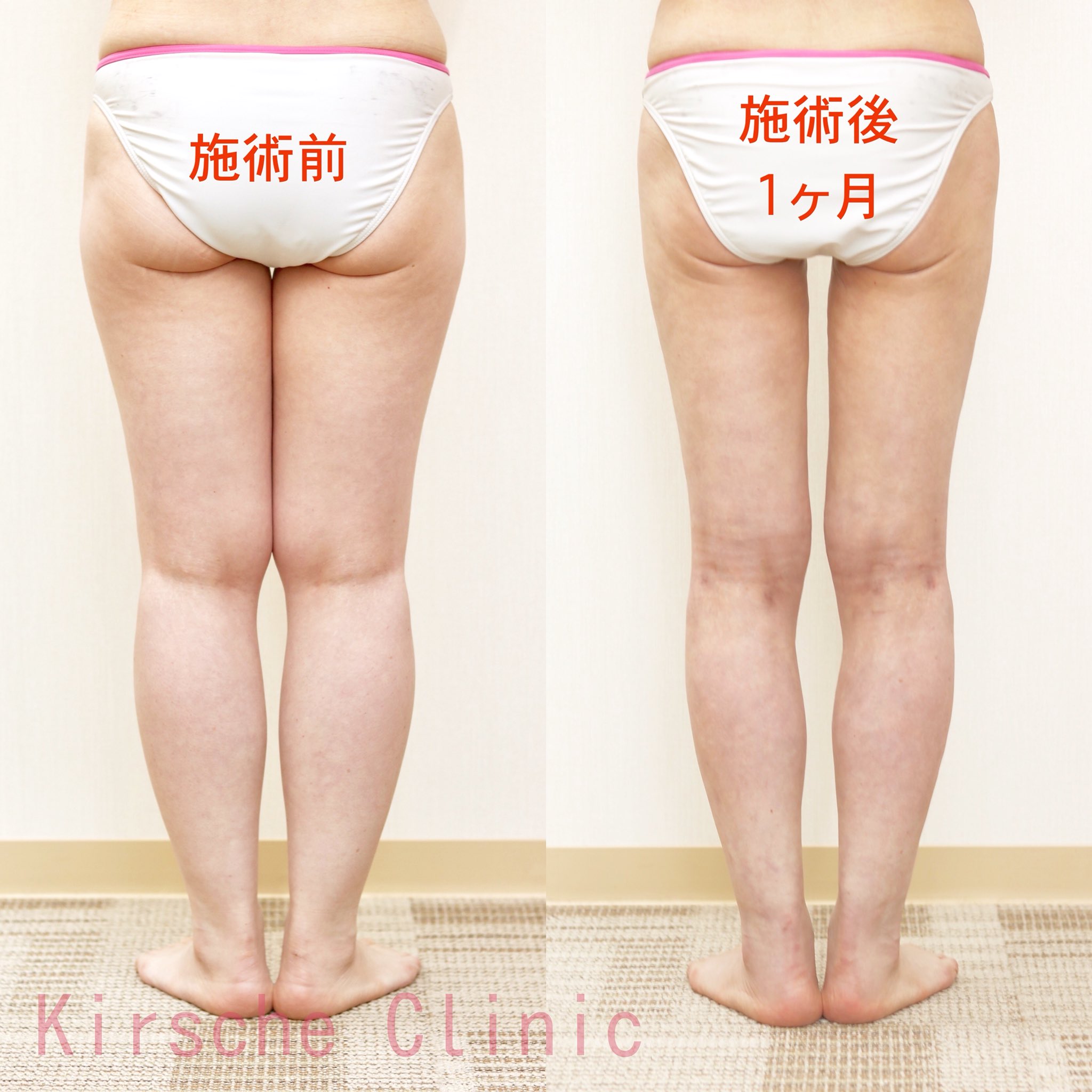 キルシェクリニック Dr めかた わずか1ヶ月で 太もも付け根 は50 4cmが43 3cmに ヒップも 5cmが80 5cmになりました 太もも付け根で40センチ前半だと 本当にスッキリ細く見えますね 細さだけでなく 脚が長く 綺麗に見えるようなデザインにもこだわっ