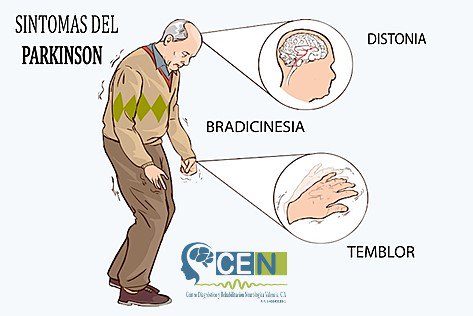 Resultado de imagen para bradicinesia