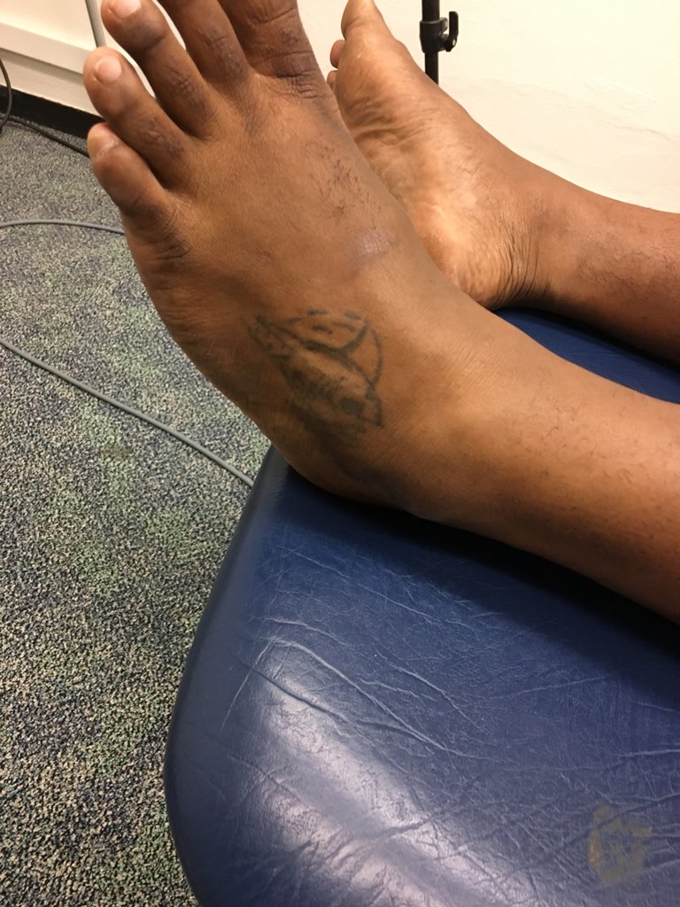 IshankaMW's tweet photo. Learning from amazing cultures...In Fiji it is believed that tattooing a bad ankle will help relieve pain... #AnkleResearch #PlaceboEffect? https://t.co/KML1eO7tmj