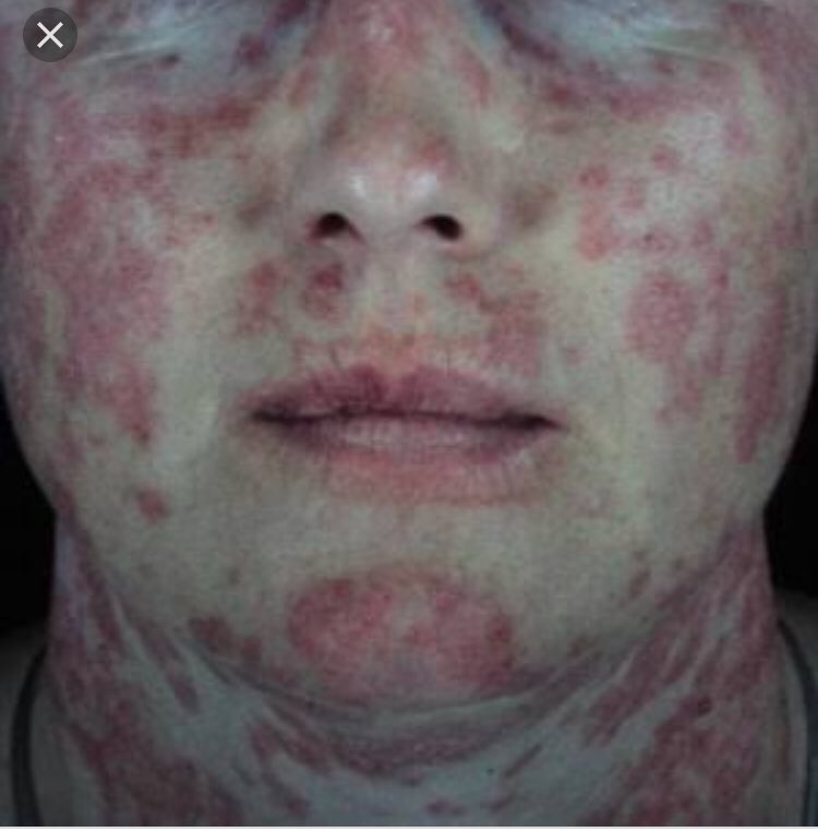 Lolo Lekgoane on Twitter "SAVE A LIFE!!!!! Symptoms of Lupus…