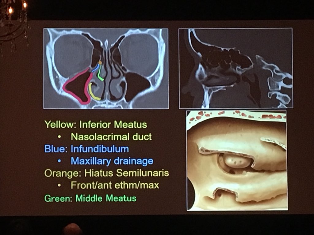 nakoontz's tweet photo. @LNLedbetter gives a spectacular review of sinus anatomy and inflammatory sinus disease β complete with #ShockAndAwe intraoperative videos! #UtahHN18 #StopOvercallingObstructiveSinusDisease #ListenToLuke #LukeKnows https://t.co/tmGzObSwXa