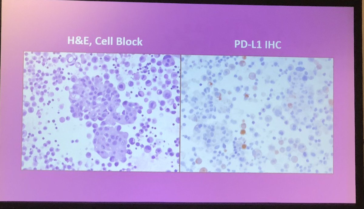 NU_Pathology's tweet photo. Take away points from Dr. Zhou platform presentation, Although PD-L1 could be negative in primary lung carcinoma, it could be positive in the metastatic lesions! #USCAP2018 #IamUSCAP #pathology #Cytopath https://t.co/9ZVoSbApvW
