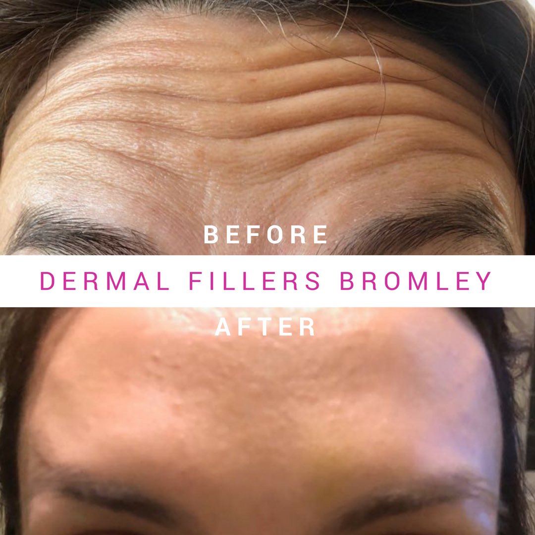DermaFillersBR1's tweet photo. My gorgeous client was fed up of her forehead wrinkles so decided to try Botox for the first time.
https://t.co/x3Imqk31nd
#botox #fillers #bromley #beckenham #London https://t.co/HKaGnaePVG