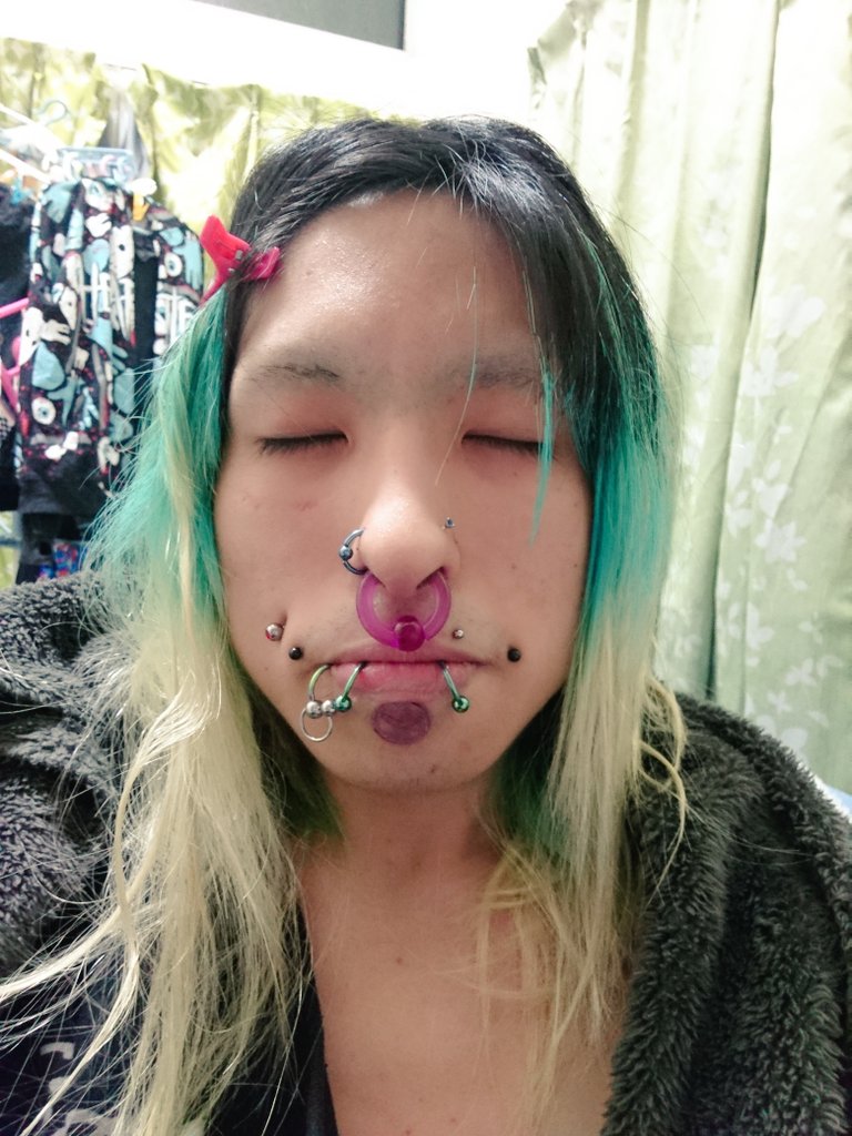 セプタム拡張 セプタム拡張