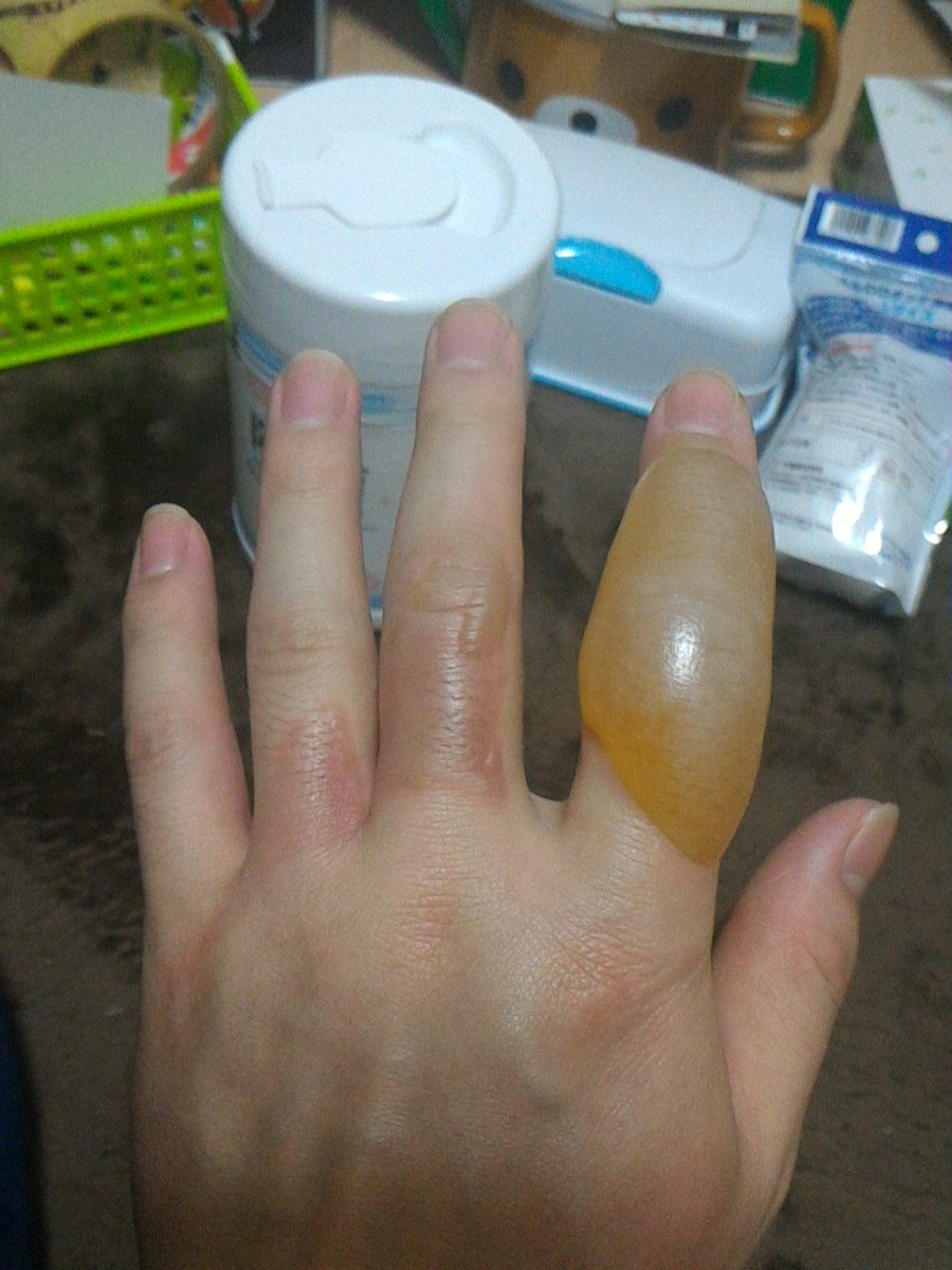 もちわか Auf Twitter 8日目 膨れ上がった皮が傷口に馴染んで来た 中指の水ぶくれも吸収されてるし 昨日潰れた薬指の皮も問題なし 火傷痕はまだまだやろうけど 痛みなく動かせる日も近い もちわか Auf Twitter 8日目 膨れ上がった皮が傷口に馴染んで来た 中指の水ぶくれも吸収されてるし 昨日潰れた薬指の皮も問題なし 火傷痕はまだまだやろうけど 痛みなく動かせる日も近い