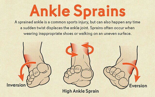 Tips kesihatan , tips rawatan kaki , rawatan kaki terseliuh , ankle sprains , cara merawat kaki terseliuh 