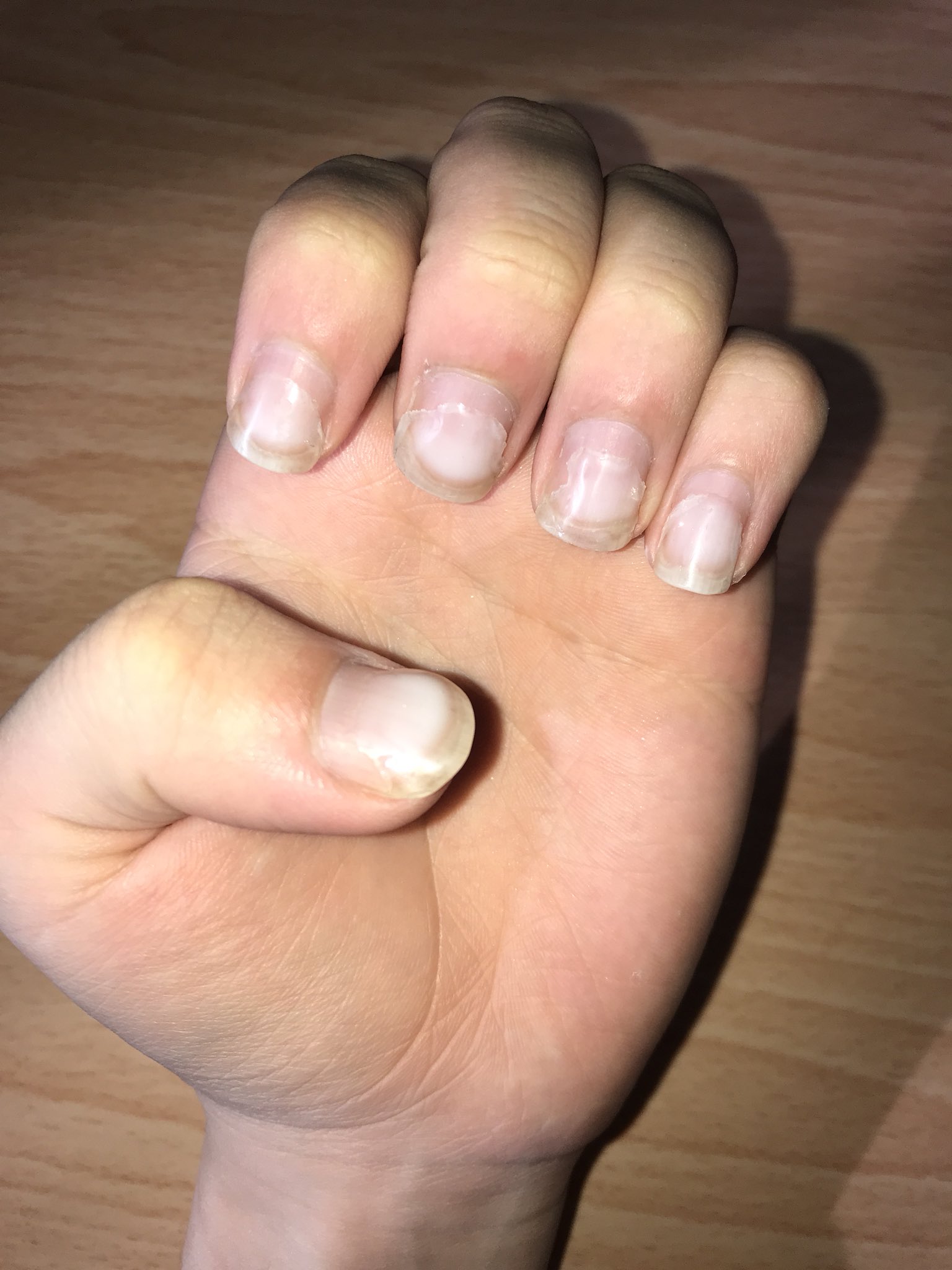 キンピア 爪育etc 爪を噛んで後悔する夢で目が覚めた今日この頃です 私は今回出来るだけオフせずに爪が生え変わるのを待ちます ダサいですが オフして爪が薄くなり匙状爪 スプーンネイル になる