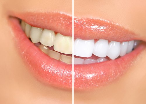 Do you want whiter teeth as part of your #TransformationTuesday? Well with our multiple whitening solutions you can!
Our dentists are trained in several different whitening methods, meaning you can have results like these