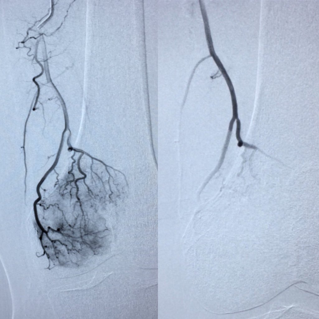 JesusBPMD's tweet photo. Patient with a femur tumor —> Particle embo💉 —> Less surgery bleeding. With @jlriosr #IamIR #IRad #IRads #IloveIR #interventionalradiology #Particlembo #embolization #interventional #minimallyinvasive #pathtoIR @SIRmembers @MedicinaUP @SIRspecialists https://t.co/YJN7rlkaKz