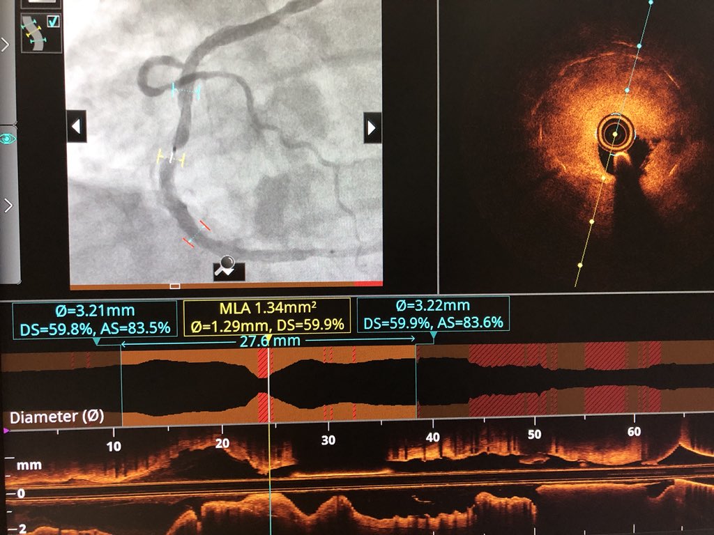 PrecisionPCI's tweet image. #OCT of the RCA shows ISR and 3mm gap between stents that couldn’t be seen on angiography. Improving outcomes by using #PCIOptimization and #radialfirst 👍 The future of PCI is here!