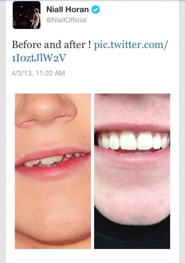GreenandBlue28_'s tweet photo. 5 years old today Niall got his braces off he was so happy he tweeted about it and he couldn’t stop smiling https://t.co/zy7fw549Gi