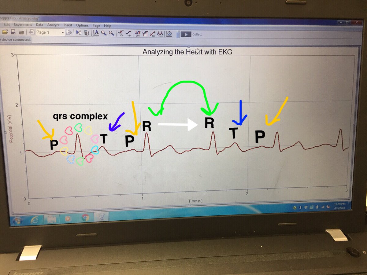 AMARYEVPBS's tweet photo. Standard 35 : EKG Diagram #RHSBMS https://t.co/1QTSXGKu63
