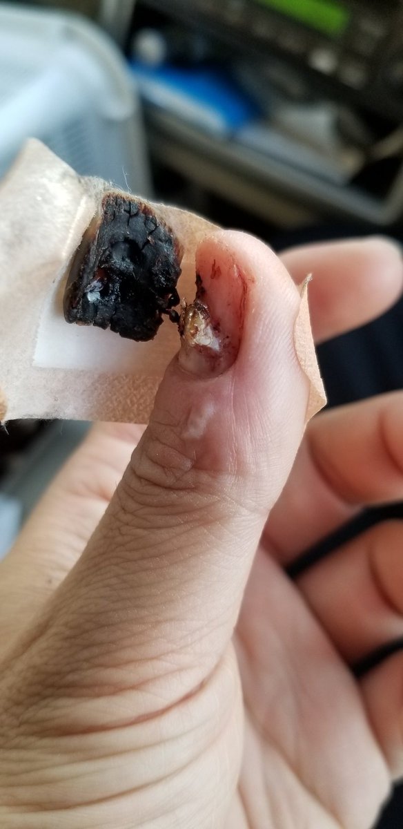 田辺トス Pa Twitter 爪剥がれた直後は熱痛い感じですけど すぐ皮膚が固くなって大丈夫になりますね 僕は足の親指の爪がよく剥がれます お大事に 田辺トス Pa Twitter 爪剥がれた直後は熱痛い感じですけど すぐ皮膚が固くなって大丈夫になりますね 僕は足の親指の爪がよく剥がれます お大事に