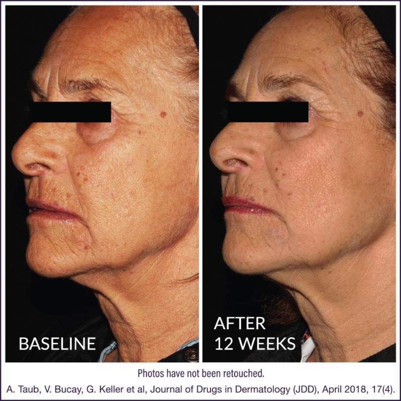 DefenAge® Skincare was recently recognized as a best-in-class anti-aging solution, helping individuals turn back the clock in just 6 weeks.   

jddonline.com/articles/derma…