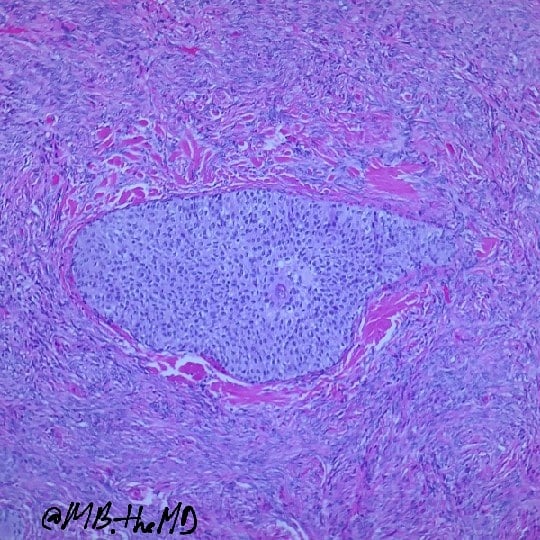 MB_thepathMD's tweet photo. #pathology #pathresident #pathArt #pathcases https://t.co/EsMcekK5JH