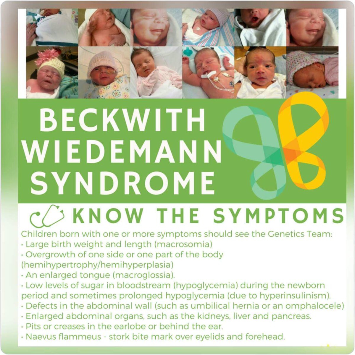 HowBigBWS's tweet photo. Tag a pediatric provider so the symptoms aren't missed #bwsawareness #symptoms #Pediatrics #beckwithwiedemannsyndrome https://t.co/GtdANlUmEl