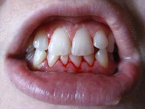 ayurvedicpharma's tweet photo. #Pyorrhoea is characterized by copius discharge of pus from the roots of the teeth and gums. The pus is often swallowed along with food and is absorbed into the gastrointestinal tract causing further diseases. https://t.co/nP2rleoy0s https://t.co/pMRIjibz90