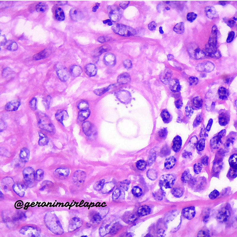 GeronimoJrLapac's tweet photo. M, 34YO - Lymph node. Lymphadenomegaly + fever+ anemia.
The most beautiful H&amp;E I've ever seen of this disease!
@JMGardnerMD @smlungpathguy @kriyer68 @pembeoltulu @pranavp01 @histolover @NejibY @BinXu16 @DraEosina @luishcruzc @VijayPatho @steland011 @mydermpath https://t.co/xfLRNcntkJ