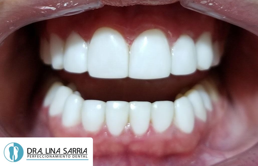 dralinasarria's tweet photo. Diseño de sonrisa en resinas de alta estética por la Dra Lina Sarria😃

Dra Lina Sarria - Perfeccionamiento Dental 😃

#odontologia #disenodesonrisa #odontolove https://t.co/C1mcJbLTPm