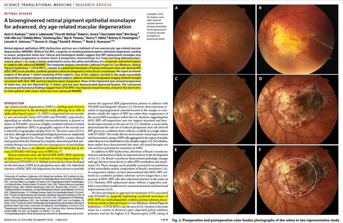 Pdf Stem Cell Treatment For Age Related Macular Degeneration The Challenges