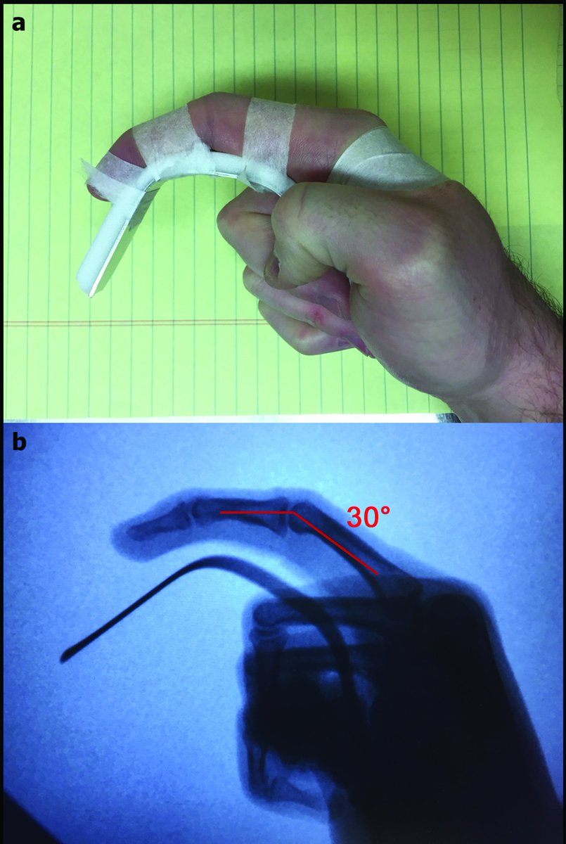 ORTHOJournal's tweet photo. New #smartphone apps hold promise for providing measures of finger ROM as accurate and reliable as those of the standard goniometer and visual inspection. https://t.co/ZpRg2mFIkc #app #orthopedics @UPMCnews @jrfowlermd https://t.co/gMAjJBzN7n