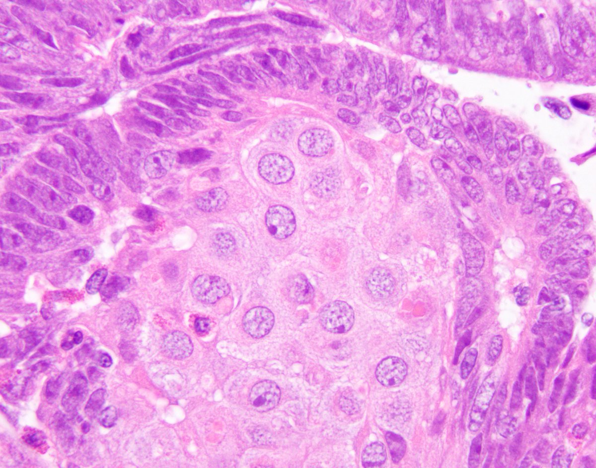 arp press on twitter enjoy these lovely squamous morules in a