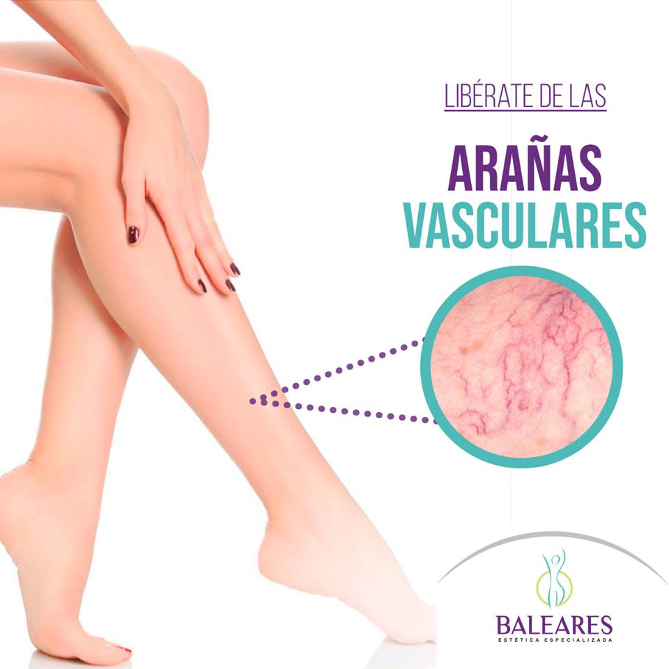 balearesperu's tweet photo. El 50% de las mujeres y hombres sufren de arañas vasculares y várices antiestéticas, las cuales poseen un alto componente hereditario. ¿Padeces de ello?Entérate más aquí >>> https://t.co/WhFgXjj3AX

#ClínicaBaleares #Várices #ArañasVasculares #ClinicaBalearesPeru https://t.co/f85iWofTdT