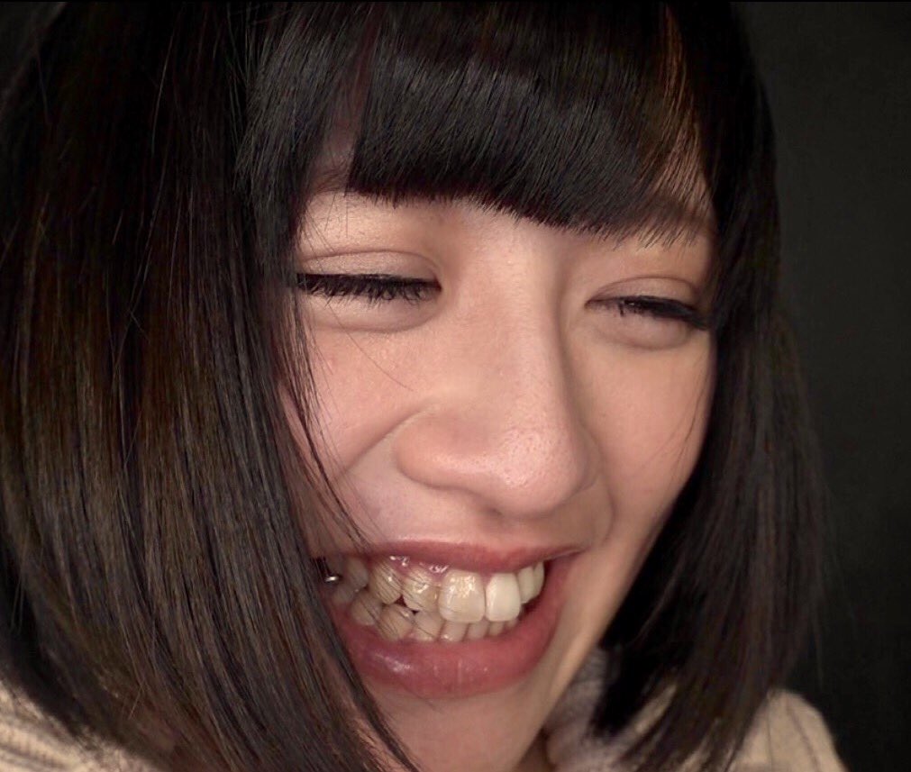 egudarausu's tweet photo. 久々の銀歯画像（＾∇＾）葉月もえさん😃 https://t.co/HhcEUZZUt7