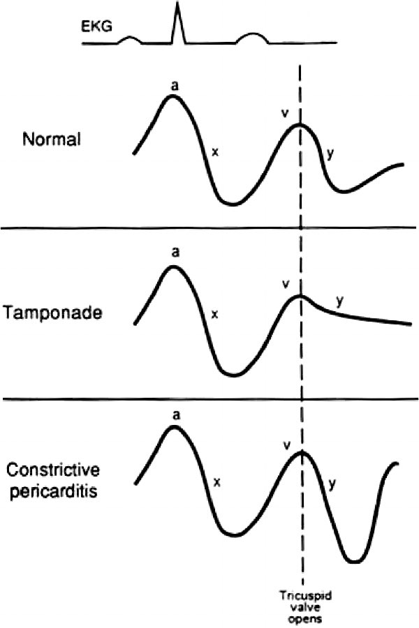 duanepinto's tweet photo. @JerroldLevy π« 2 malign or stereotype but Iβm horrible @ vent. I know it.
CCM very ππ½ echo/noninvas hemos (great 4 some situations!) but AS, MS, MR, dHF, AMI, failing RV on #impella, #bipella, etc is like me & vent if π«pulm edema π Letβs remedy knowledge gap together! Here a start. https://t.co/ppEBxbvgQ9
