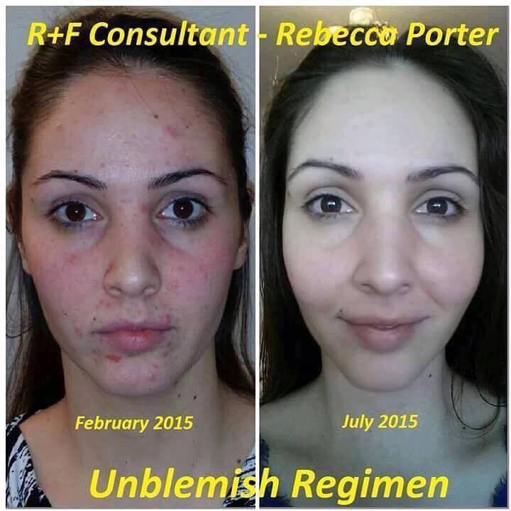 SavvyD96's tweet photo. It doesn’t matter what age you are - teenager or adult, NO body likes having pimples. Say GOODBYE to acne!!! With Rodan + Fields Unblemish! https://t.co/Qe1WDfdLrb