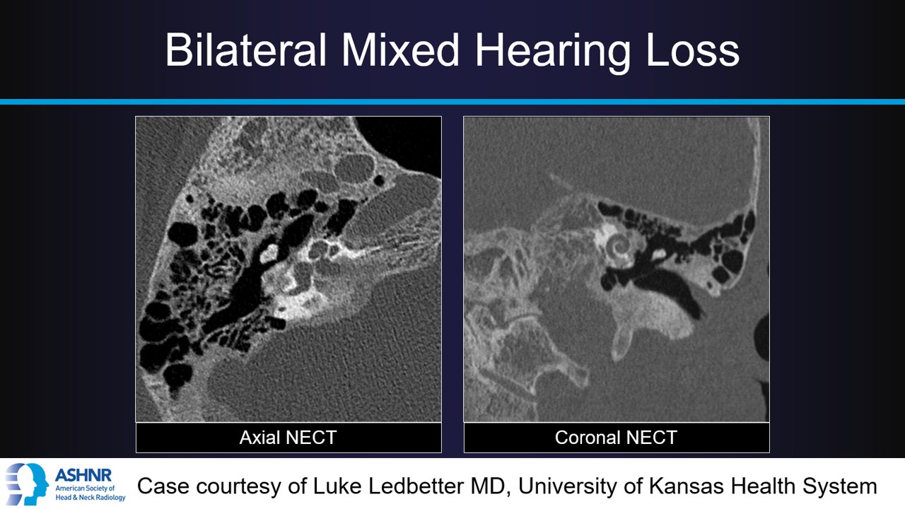 ASHNR on Twitter "ASHNRCOTW 3 Bilateral mixed hearing loss
