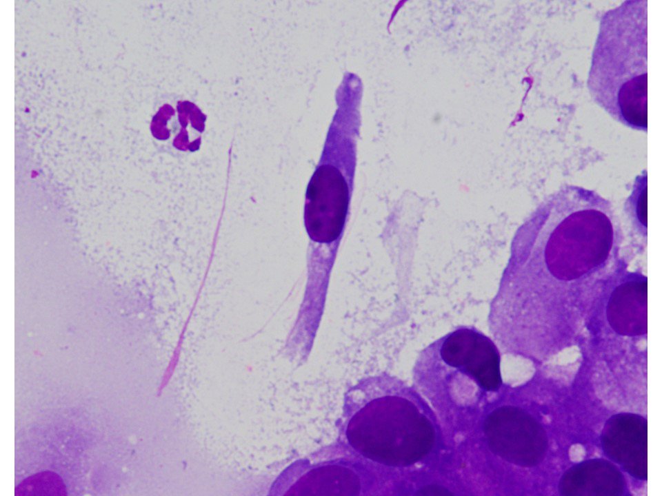 Touch prep from liver lesion - metastatic urothelial carcinoma. Helpful clue is the abundant cercariform cells: elongated cells w long cytoplasmic tails #cytology #cytopath #uropath #pathology #pathclues