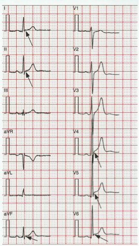 SIAC_cardio's tweet image. Imperdible Revisión de #RepolarizacionPrecoz por Peter Macfarlane #ECGfirst #ElectroSIAC  @adribaran siacardio.com/editoriales/la…