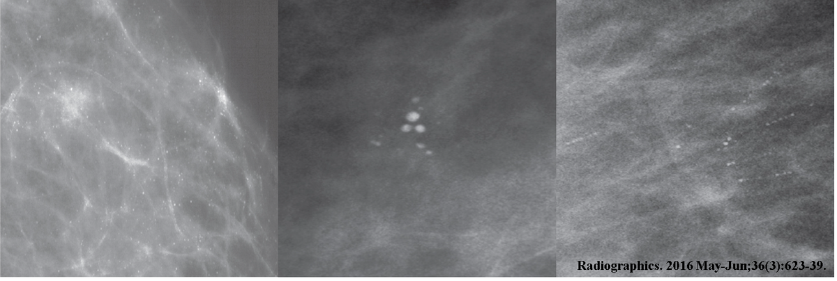 RMilesMD's tweet image. Distribution is key when evaluating round calcs from baseline #mammogram:  
Diffuse: Benign at screen
Grouped: Short-Term Follow-up after diagnostic
Linear/Segmental: Biopsy after diagnostic
#RadResCase #BreastCalcs #BreastBx #BenignBreast

Click Image to Enlarge