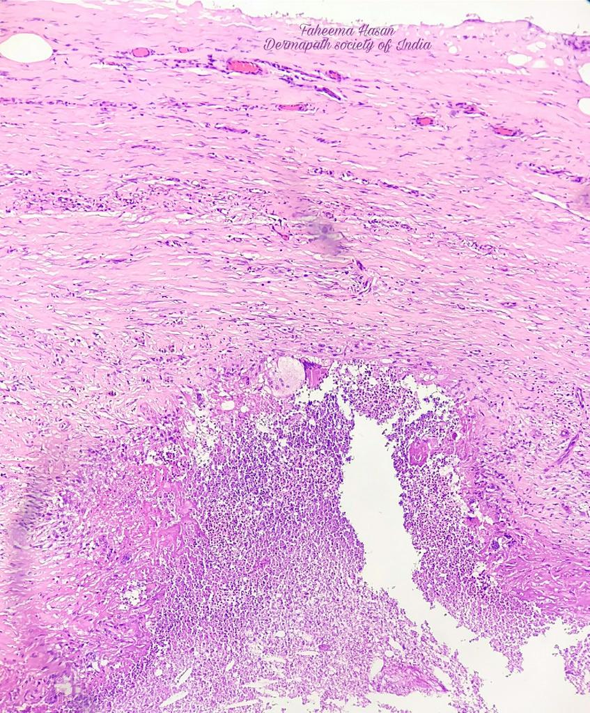 faheema_hasan's tweet photo. A case of phaeohypomycosis..
And a beautiful #PathArt ..
@pembeoltulu https://t.co/1ygkLoByEE