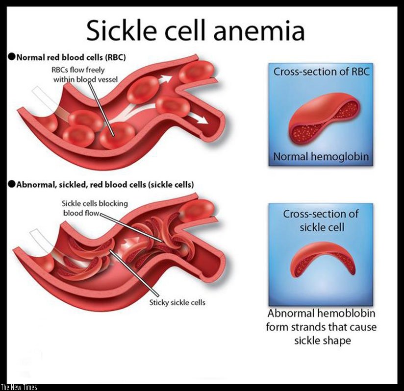 Sickle cell anemia traced to its origin 7300 years ago: a West African who mutated a gene carrying the disease, as natural defense against malaria. Fascinating medical story of DNA detective work: qz.com/1226427/everyo…