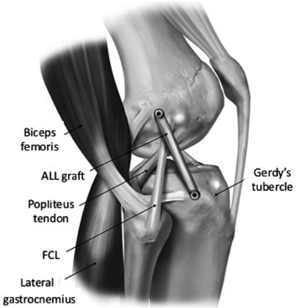 aossmjournals's tweet photo. ALL reconstruction and lateral extra-articular tenodesis both biomechanically result in reductions of tibial internal rotation. However, the influence of overconstraint still needs discussion: https://t.co/Pt9iIDjg3D https://t.co/Ow7a3pYL3R