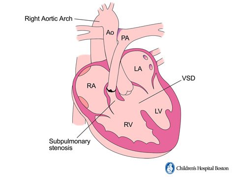 Fortunately, in spite of Gregory’s death, Dr. Lillehei and his team pressed on. In the end, cross-circulation allowed them to repair several defects for the first time that had never been treatable before: VSD, AV canal, tetralogy of Fallot.