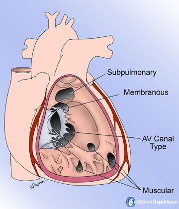 Fortunately, in spite of Gregory’s death, Dr. Lillehei and his team pressed on. In the end, cross-circulation allowed them to repair several defects for the first time that had never been treatable before: VSD, AV canal, tetralogy of Fallot.