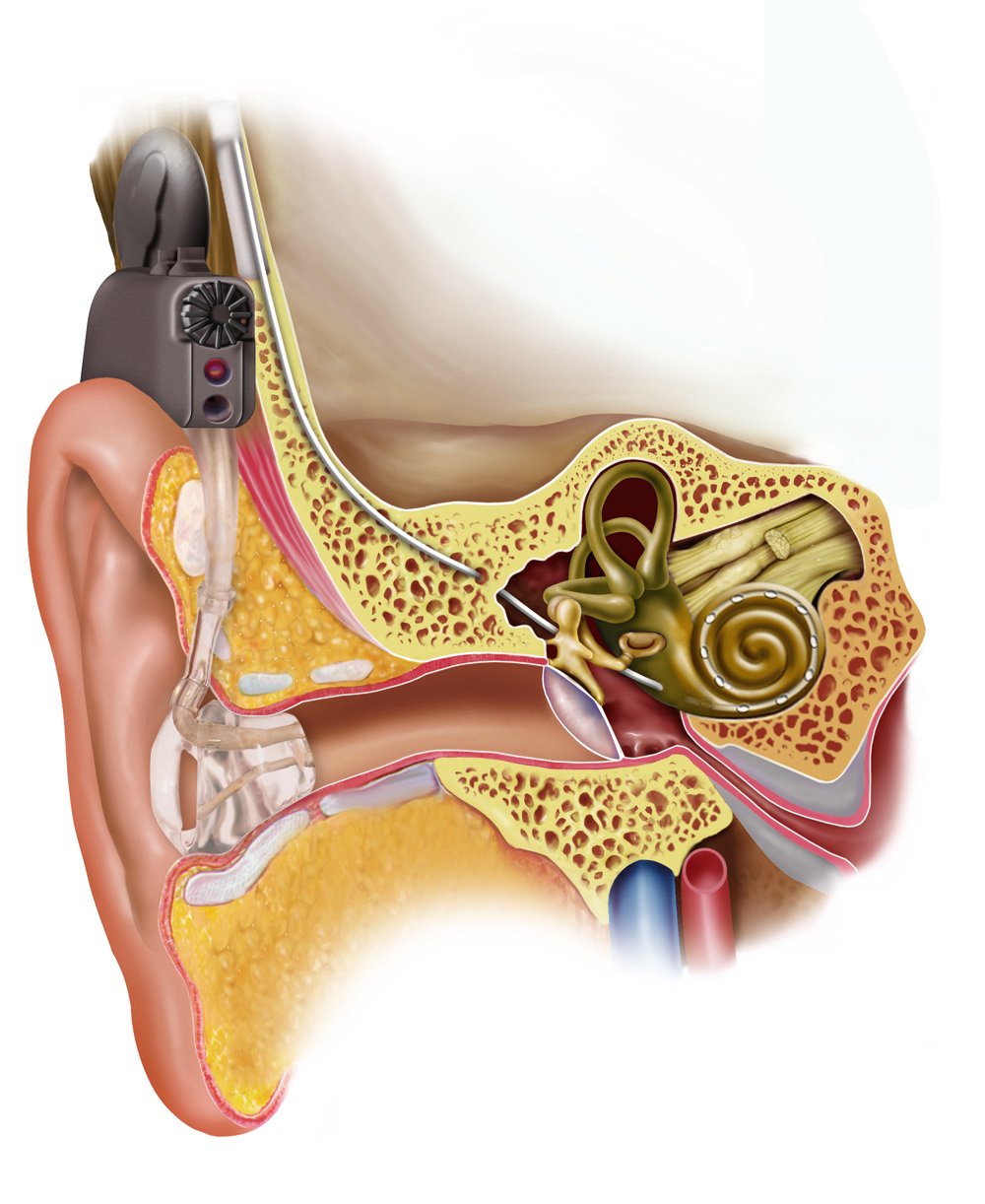Кохлеарная имплантация строение уха
