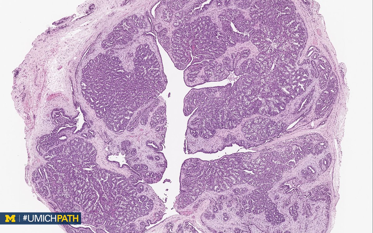 UMichPath's tweet photo. 🔬 #DailyDx theme this week: Vulvovaginal #Pathology

➡️ What’s your diagnosis of these two lesions (from different patients)?

➡️ What can you predict about one patient versus the other?

➡️ We’ll tweet the answers, some quick facts, and the next case tomorrow! #UMichPath https://t.co/fc5nl84UWl