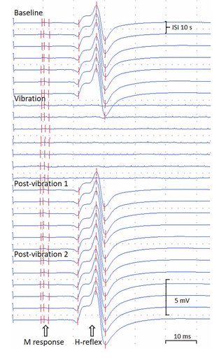 elektrophysiologie menschlicher muskeln