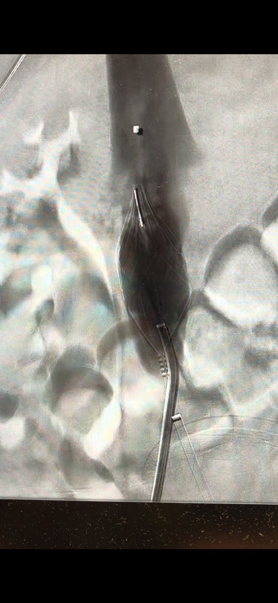 DrNatour's tweet photo. Widow maker captured by Angel catheter in a trauma patient .. Suction thrombectomy using @penumbrainc CAT 8 .. then replaced by a retrievable filter ! #iRad  @SIRRFS @ATSTrauma #filterout @SIRspecialists @ https://t.co/icKxUjbQZW