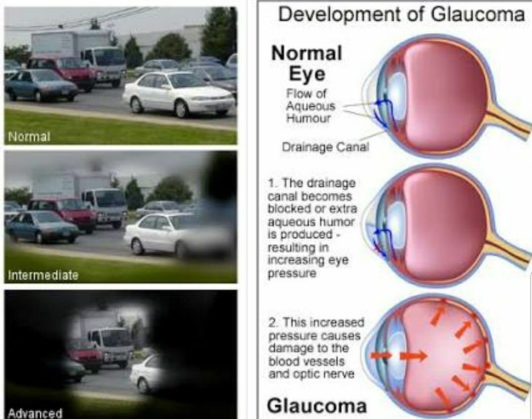 'Silent theif' Thats what they call glaucoma! Make sure you protect your sight from theft! #stalbanseyespecialists #glaucomascreening