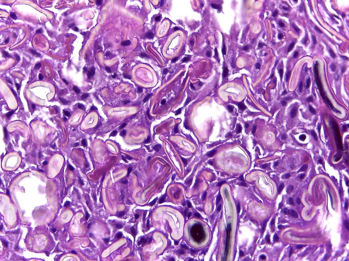 More of path curiosities 
Rushton bodies
Exclusive from odontogenic cyst
Not confuse them with ghosts cells 👻 

#oralpath
#oralpathcl