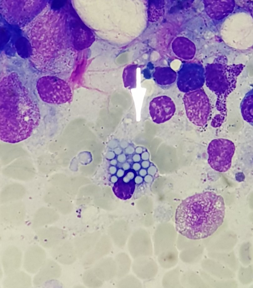 AMartinezRocaMD's tweet photo. Bubble madness! #mottcell #MM #Russellbodies #hj23 #hemepath https://t.co/j0bNOxiqMO