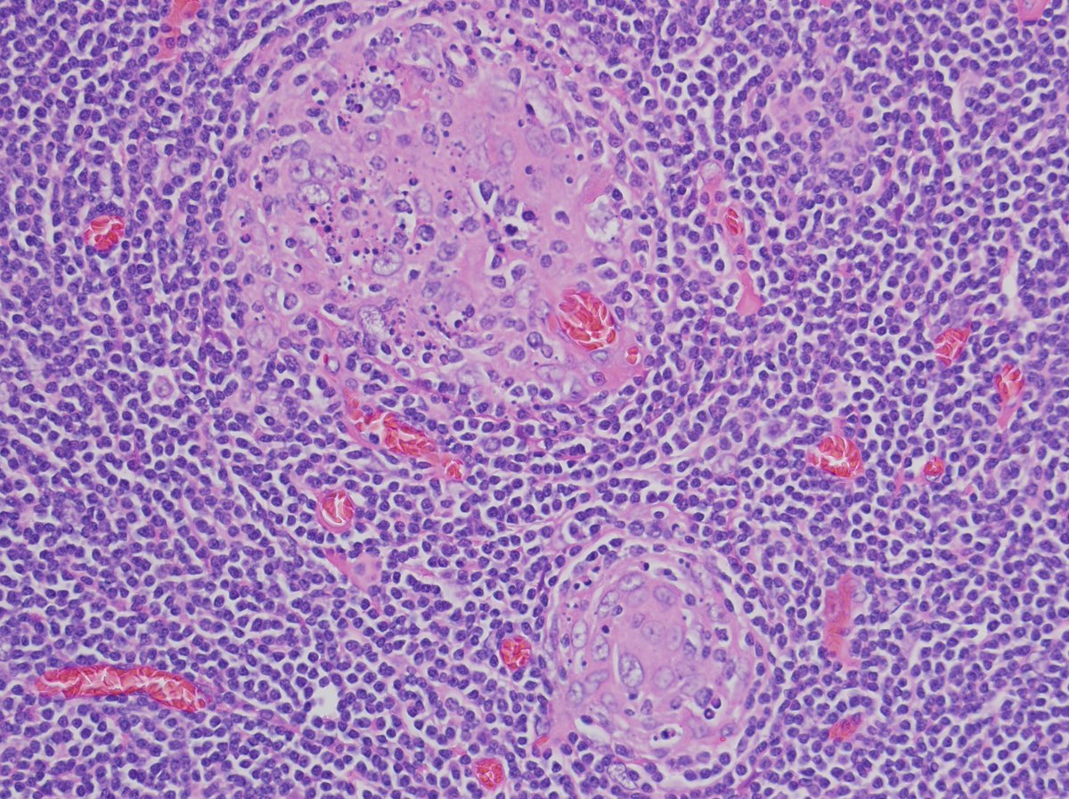 люпус нефрит гистология. криптококковый менингит гистология.